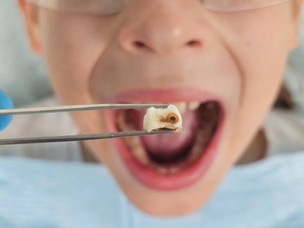 Best Emergency Dentist for Knocked-Out Tooth in Arcanum, OH